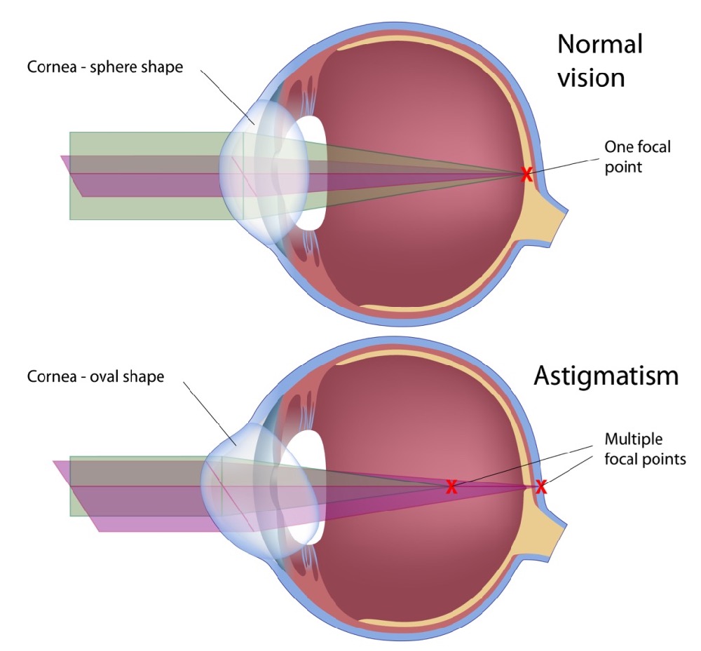 How To Treat Astigmatism Alexandria VA How To Treat Astigmatism Alexandria VA