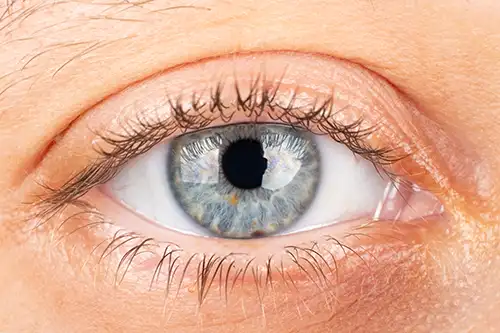 VisualEyes Optometrists - Corneal Dystrophy