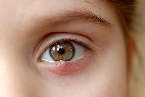 VisualEyes Optometrists - Eye Care For Hordeolum (Stye)